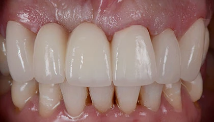 After implant